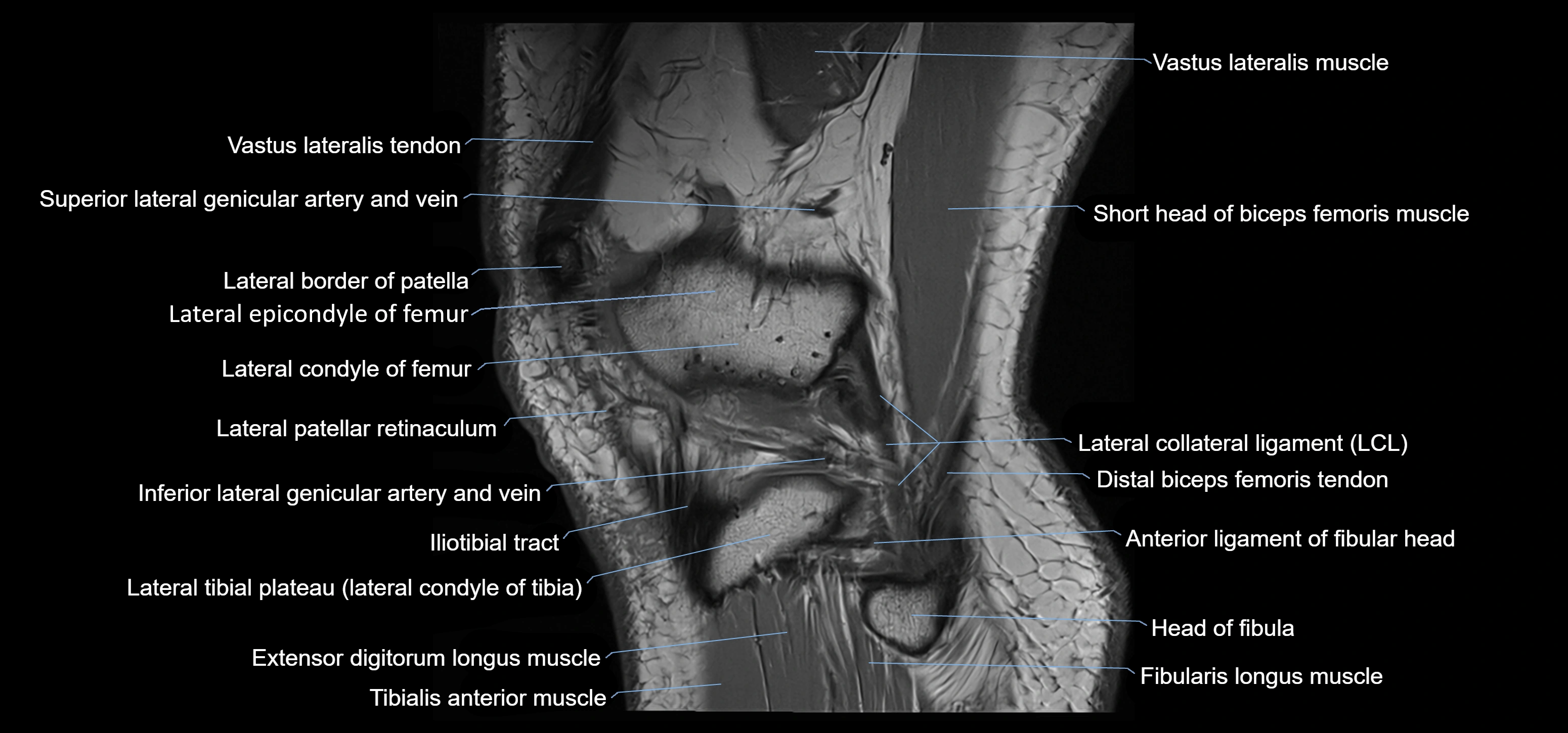 MRI knee sagittal cross sectional anatomy labelled 3T radiology image-00041.webp